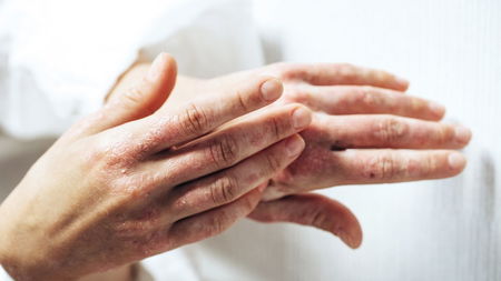 Welt Psoriasis Tag 2025